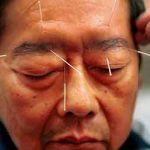 العلاج بالإبر الصينية حقيقة أم خرافة؟